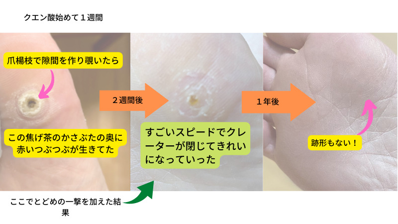 クエン酸始めて１週間　２週間後　１年後　跡形もない